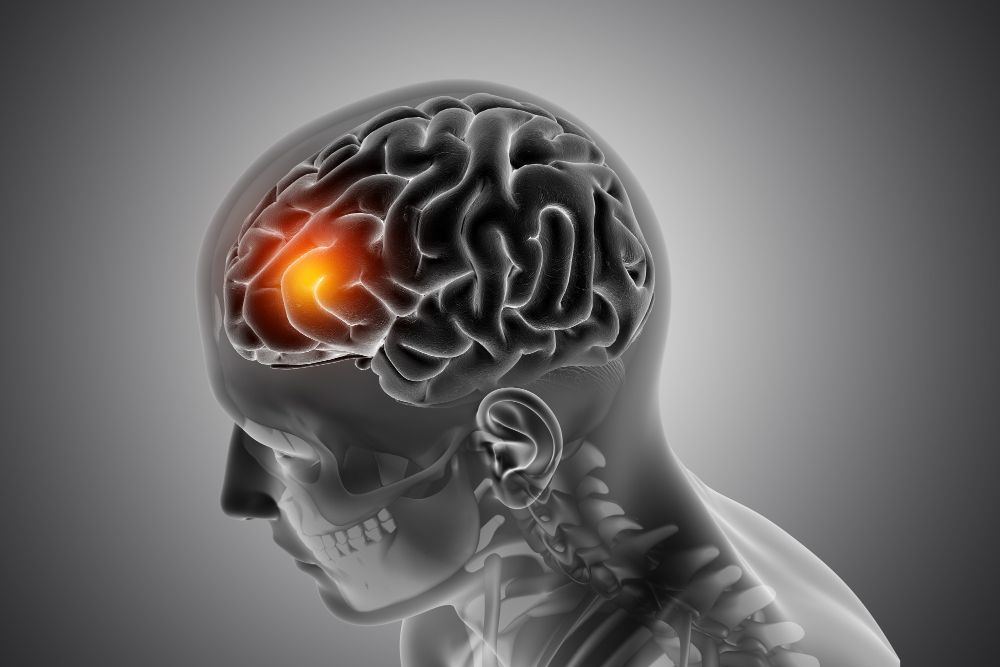 8 Tanda Tumor Otak yang Sering Dianggap Biasa Aja padahal Bisa Kehilangan Penglihatan!