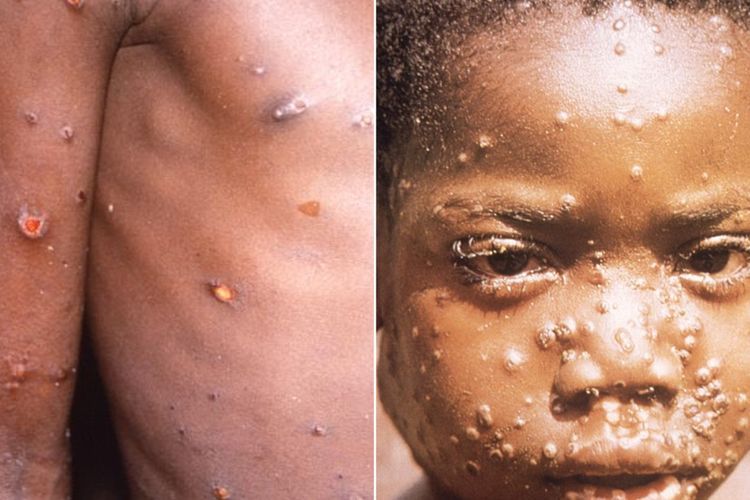 Info! Apakah Monkeypox Atau Cacar Monyet Bisa Sembuh Sendiri?