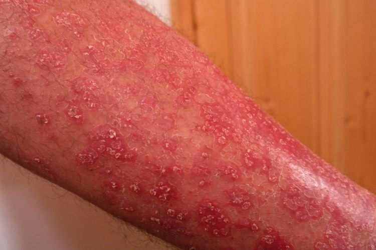 Apa yang Dimaksud Penyakit Psoriasis? 