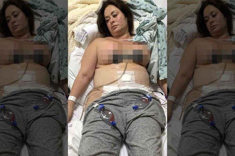 Wanita Ini Malah Kehilangan Puting Payudara, Usai Operasi Plastik