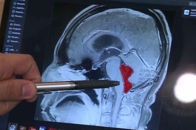 Sakit Kepala Tak Sembuh-sembuh, Ternyata  Ada Cacing Pita di Otak