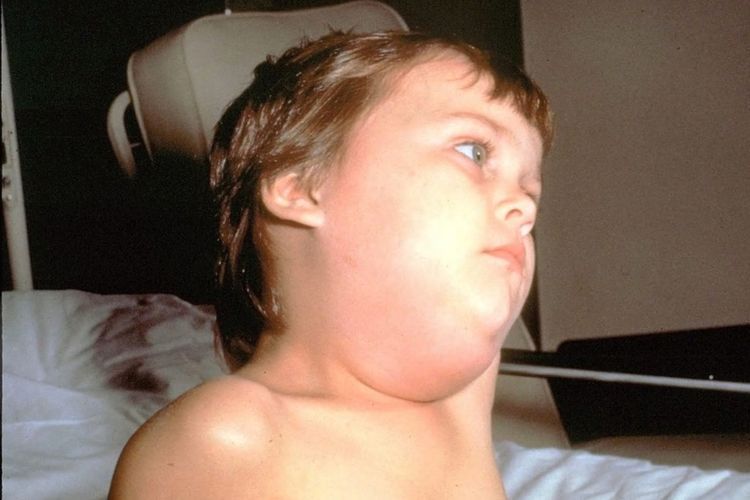 4 Cara Mengobati Gondongan Secara Alami Tanpa Obat
