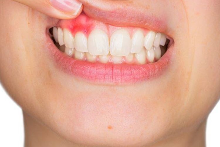 6 Cara Efektif Mengobati Gusi Berdarah secara Alami