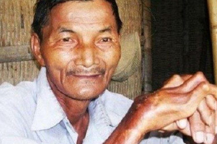 Pengakuan Seorang Pria yang Tidak Bisa Tidur Selama 33 Tahun, Derita Insomnia Akut  
