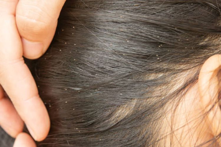 Cara Menghilangkan Kutu Rambut Beserta Telurnya, Terbukti Manjur!