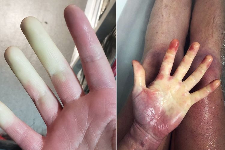 Sindrom Raynaud di Mana Penderitanya Mengalami Jari Memutih atau Biru untuk Sementara