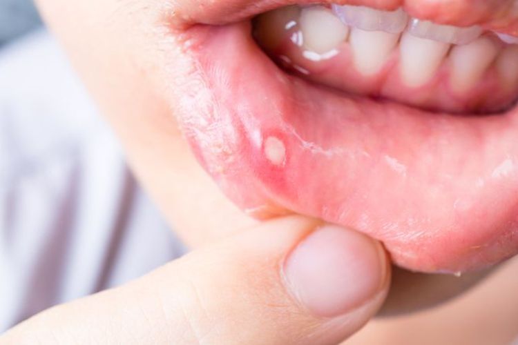 Cara Menyembuhkan Sariawan Paling Cepat tanpa Obat