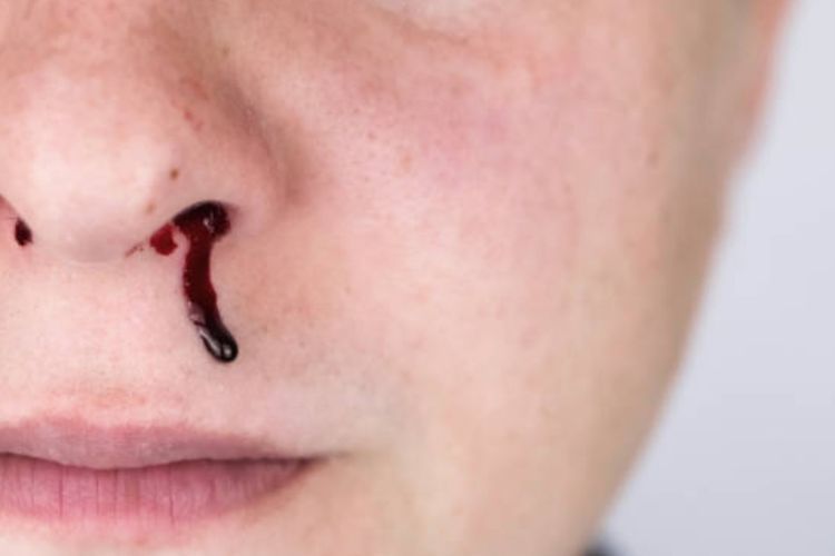 Cara Mengatasi Mimisan dan Menghentikan Pendarahan di Hidung
