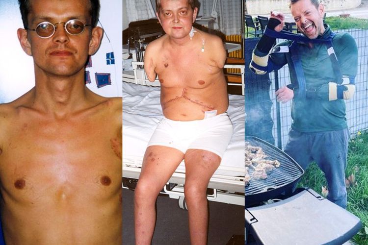 Perjalanan Inspiratif Felix, Orang Pertama yang Menerima Transplantasi Tangan Ganda