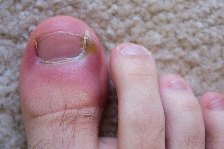 Obat Cantengan Alami yang Ampuh untuk Kuku Kaki dan Tangan