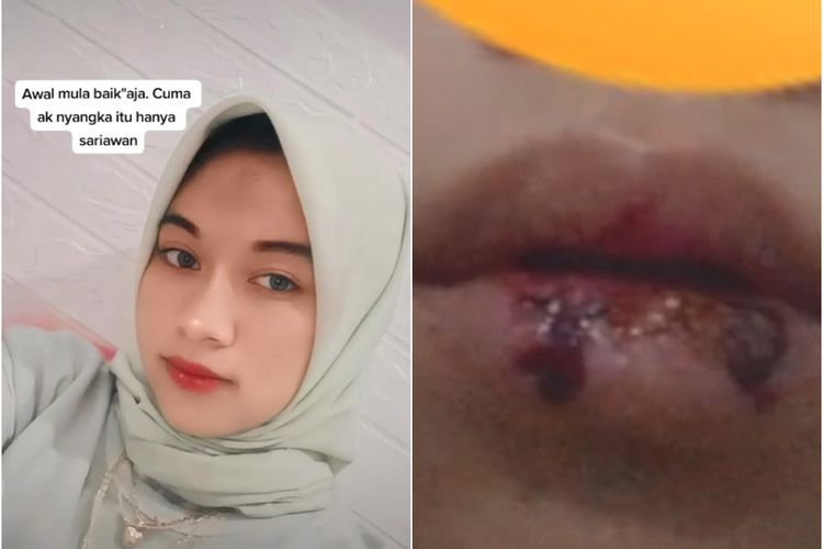 Bibir Wanita Ini Berdarah hingga Infeksi Akibat Suka Mengelupasi Kulit Bibir, Bikin Ngilu