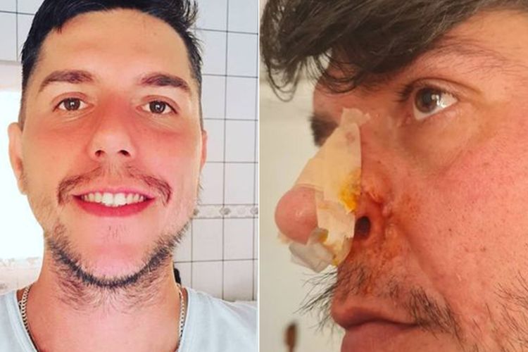 Operasi Bibir Gagal, Pria Ini Jadi Punya Tiga Lubang Hidung