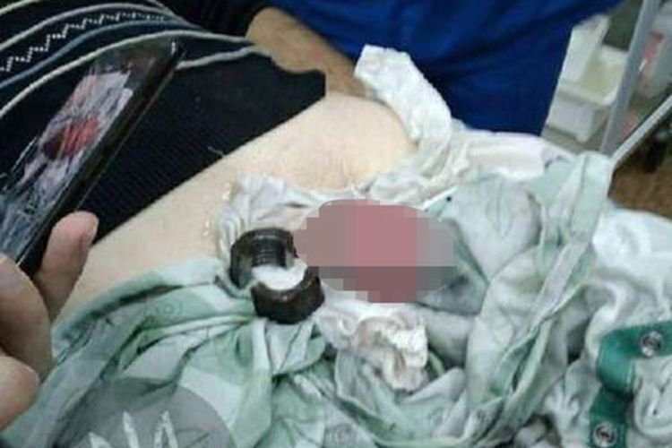 Tak Terima Diselingkuhi, Wanita Ini Pasang Mur ke Penis Suaminya