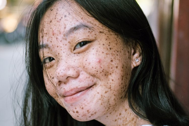Mengenal Istilah Purging, Tanda Ketidakcocokan Wajah pada Produk Kecantikan