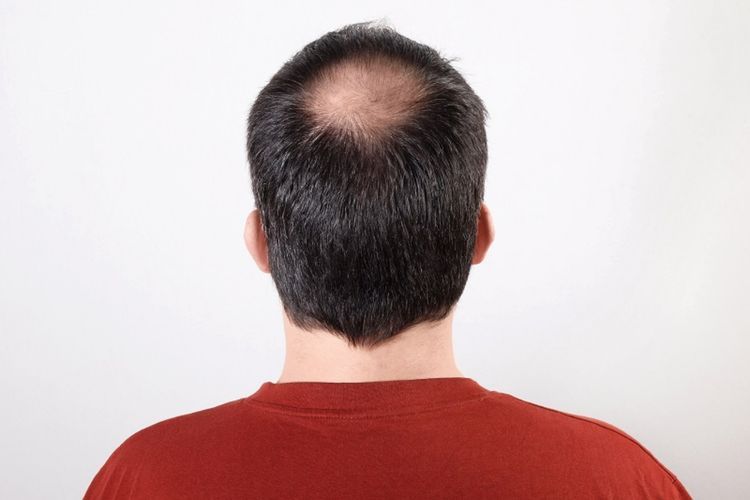 Rambut Botak di Usia Muda? Mungkin Ini Penyebabnya
