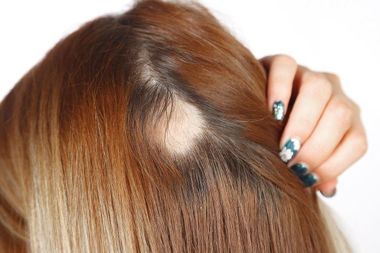 Kerontokan Rambut Picu Kebotakan dan Pitak, Begini Cara Mengatasinya