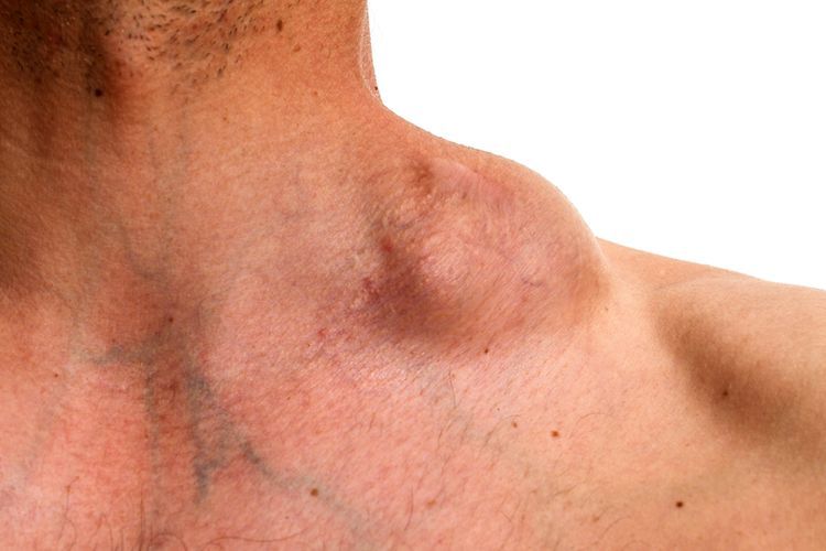 7 Gejala Kanker Kelenjar Getah Bening (Limfoma) yang Paling Umum