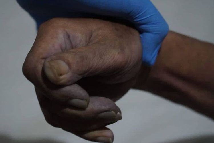 Mengenal Algor Mortis, Istilah Forensik  Penurunan Suhu Tubuh Mayat