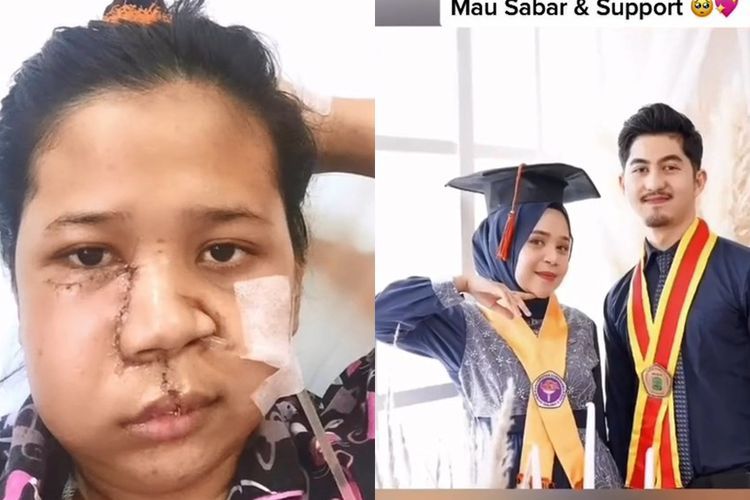 Kisah Wanita yang Punya Sakit di Wajah, Pacar Tetap  Setia & Temani Hingga Operasi