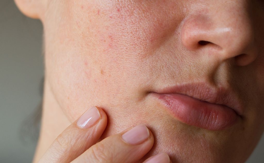 5 Masker untuk Kulit Kering dan Kusam dari Bahan Alami, Efektif!