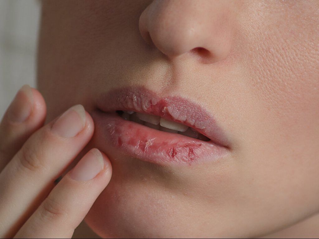 Obat Bibir Pecah-Pecah dari Bahan Alami, Terbukti Efektif!