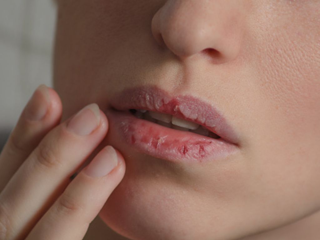 Mudah Didapat, Ini 3 Bahan Alami yang Ampuh Mengatasi Bibir Pecah-pecah