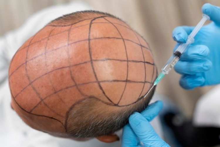 Sebelum Lakukan Transplantasi Rambut, Yuk Ketahui Efek Samping Prosedur Ini!