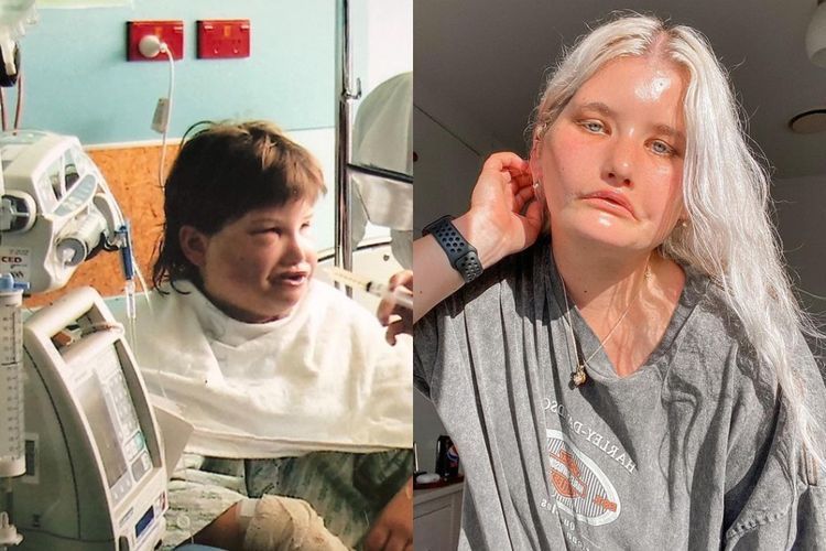Sempat Di-bully karena Tak Bisa Senyum, Wanita Ini Akhirnya Sukses Jadi Selebgram