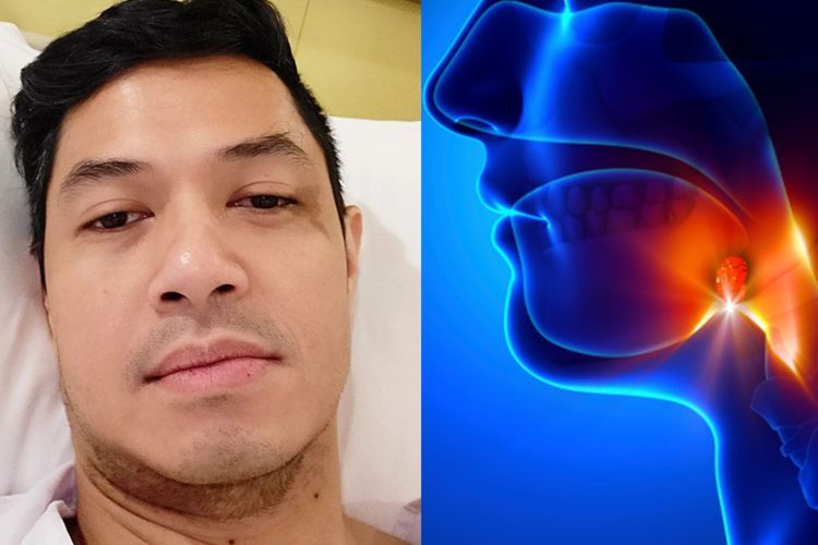 Dude Harlino Jalani Operasi Amandel, Bagaimana Prosedur dan Efek Sampingnya?