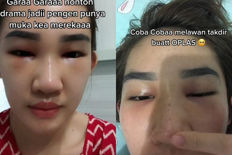 Wanita Ini Operasi Plastik Gegara Nonton Drama Korea, Begini Hasilnya