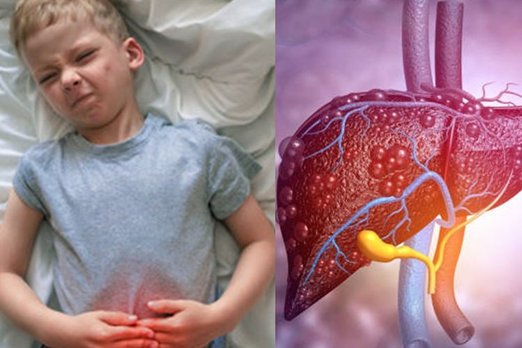 Hepatitis Akut Menular Lewat Saluran Cerna & Napas, Pemerintah Masih Terus Investigasi