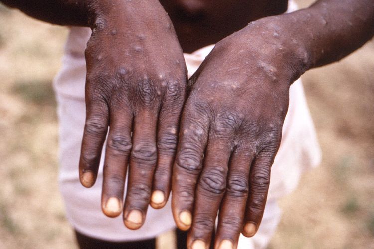 11 Negara yang Telah Melaporkan Kasus Cacar Monyet atau Monkeypox, Terbaru Australia