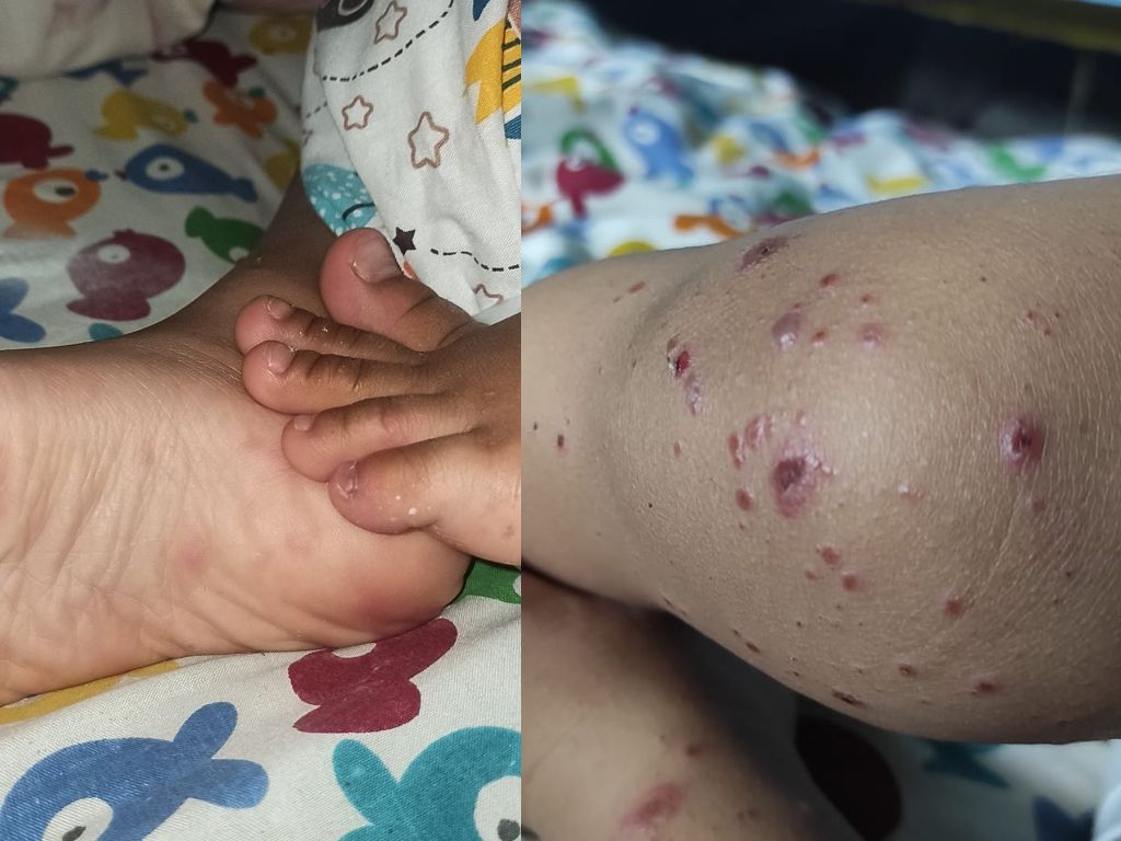 Tak Hanya Cacar Monyet, Flu Singapura juga Sedang Merebak, Waspadai Gejalanya pada Anak!