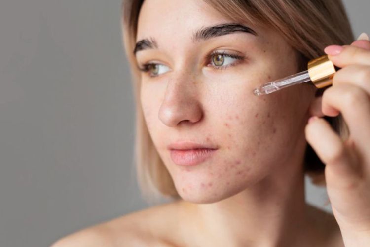 Kulit Berjerawat dan Komedo Tak Kunjung Sembuh? Beli Skincare dengan 6 Kandungan Ini