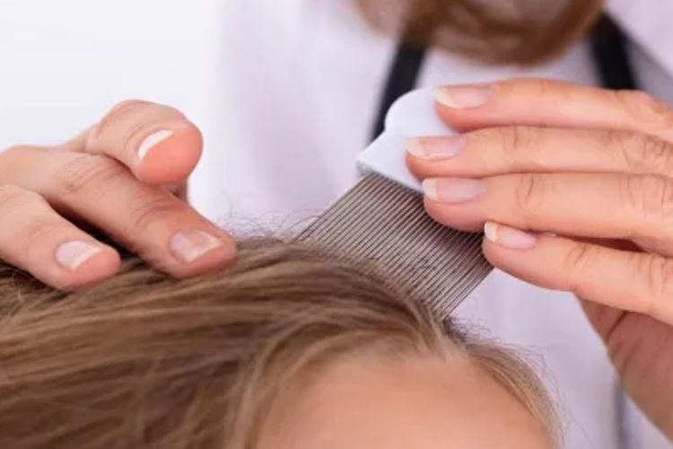 5 Cara Menghilangkan Kutu Rambut dan Telurnya, Gatal Dijamin Hilang! 