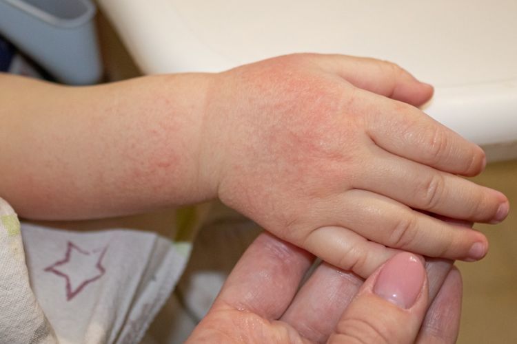 Harlequin Ichthyosis, Kelainan Kulit Bayi yang Disebabkan Oleh Mutasi Genetik