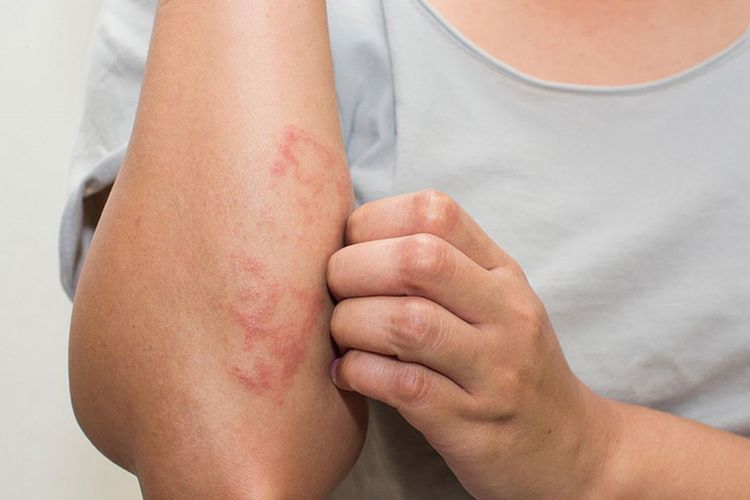 8 Jenis Ruam Merah pada Kulit Dewasa dan Anak-Anak serta Bentuknya