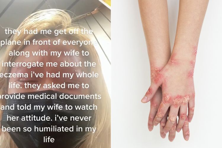 Dituding Terinfeksi Cacar Monyet, Wanita Ini Nangis-Nangis saat Diturunkan dari Pesawat 