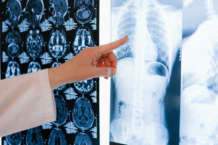 Misteri Pneumonia di Argentina yang Sebabkan 3 Orang Meninggal, Siapa yang Berisiko Kena?