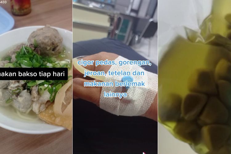 Kisah Wanita Idap Batu Empedu Usai Tiap Hari Makan Bakso dan Minuman Bersoda