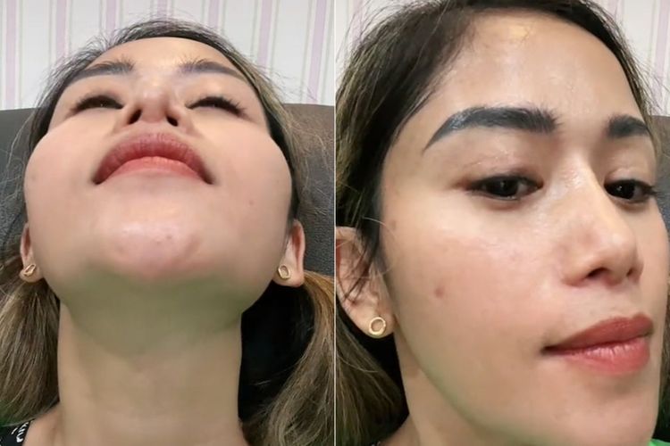 Lubang Hidung Farida Nurhan Kecil Sebelah usai Operasi, Ini Risiko Kesehatan Terkait Oplas