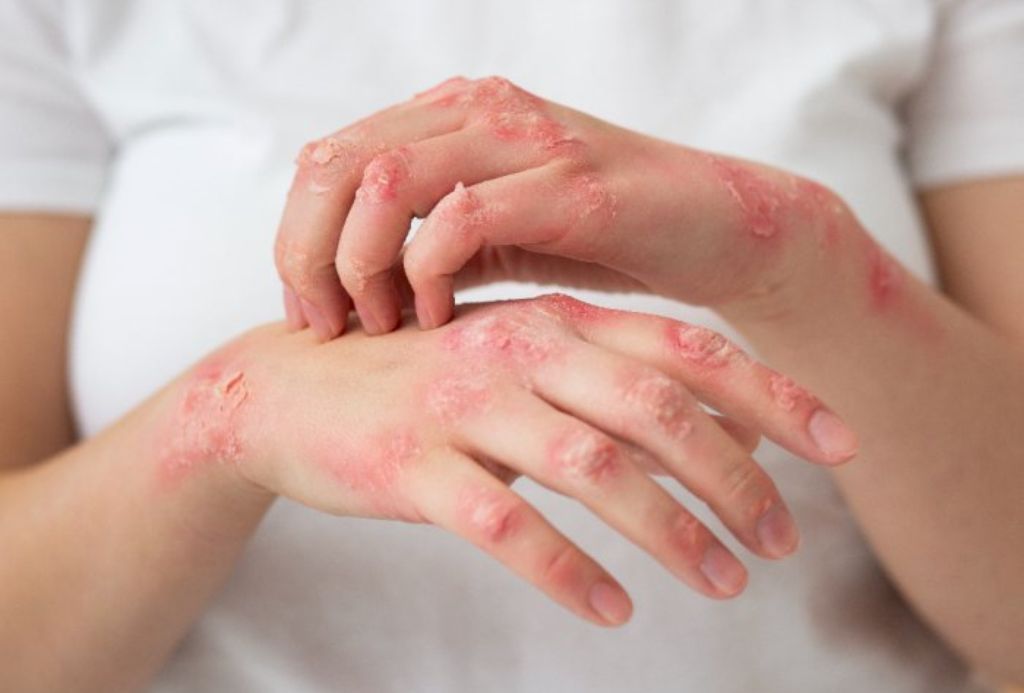 Kenali Cara Penularan Mpox dan Tips Pencegahannya