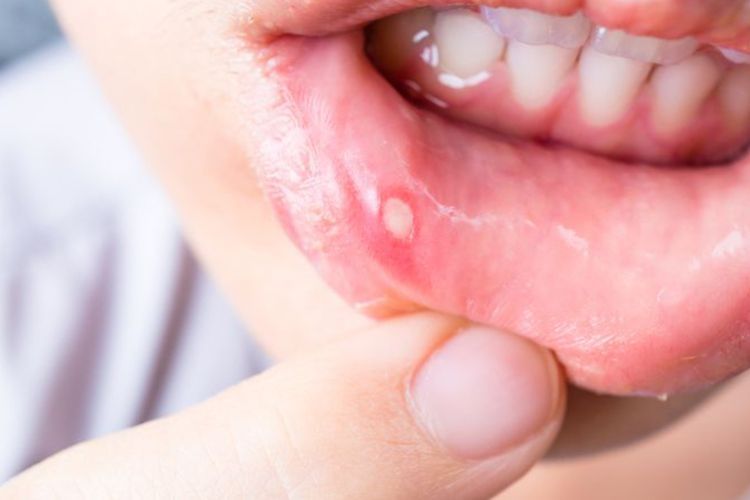 7 Obat Sariawan di Apotek yang Ampuh untuk Dewasa dan Anak-Anak