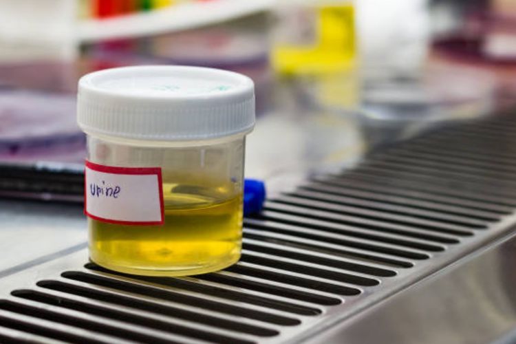 Dokter: Air Kencing yang 'Normal' Itu Warnanya Kuning 