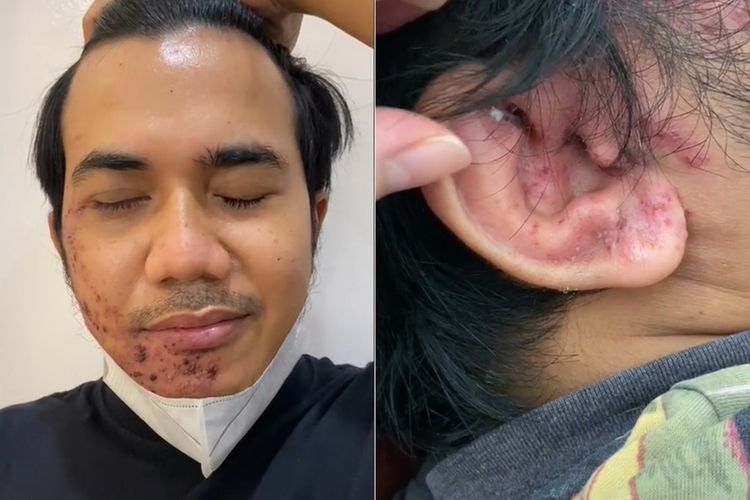Cerita Pria Kena Sindrom Ramsay Hunt sampai Gak Bisa Temani Istri Lahiran