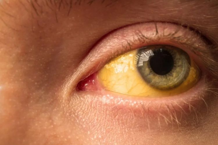 Mengenal Penyakit Kuning, Salah Satu Gejala Hepatitis 