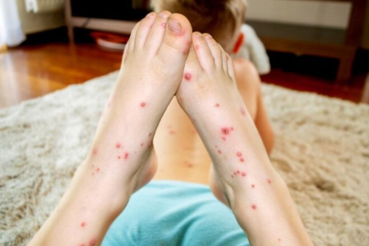  Kena Campak Enggak Boleh Mandi dan Kena Angin, Mitos atau Fakta? 
