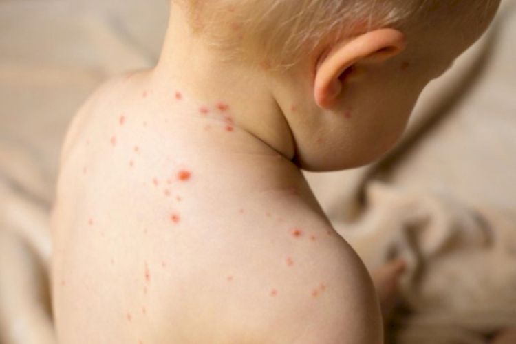 Kasus Campak Meningkat, Dokter Sarankan untuk Konsumsi Vitamin A Dosis Tinggi