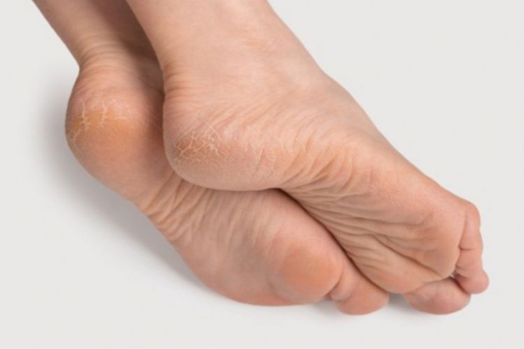 Ampuh! Ini 3 Bahan Alami Untuk Atasi Masalah Kaki Kering dan Pecah-pecah