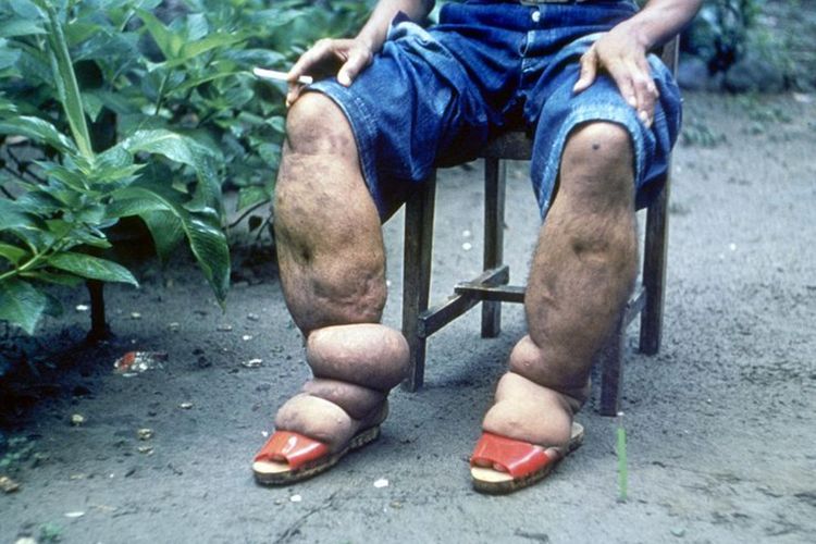 Penderita Kaki Gajah di Indonesia Masih Memprihatinkan, Kemenkes: 2022 Ada 8.635 Kasus